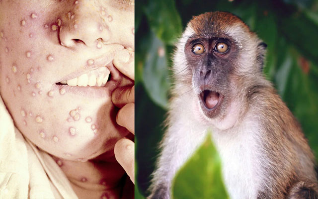 الامارات تعلن اكتشاف أول حالة لجدري القردة في البلاد