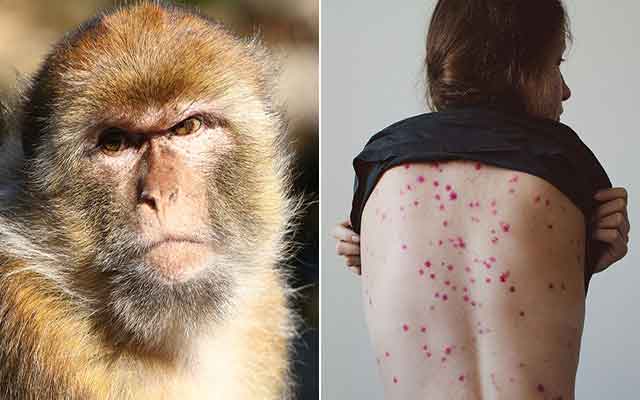 "جدري القرود" يضرب إسبانيا ووزير الصحة يحذر من ارتفاع الإصابات  